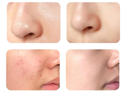 The Latest Generation Small Bubble Dermabrasion Machine - 8 In 1 Aqua Facial Peel, BIO Facial Wrinkle Remover & Skin Cleansing,